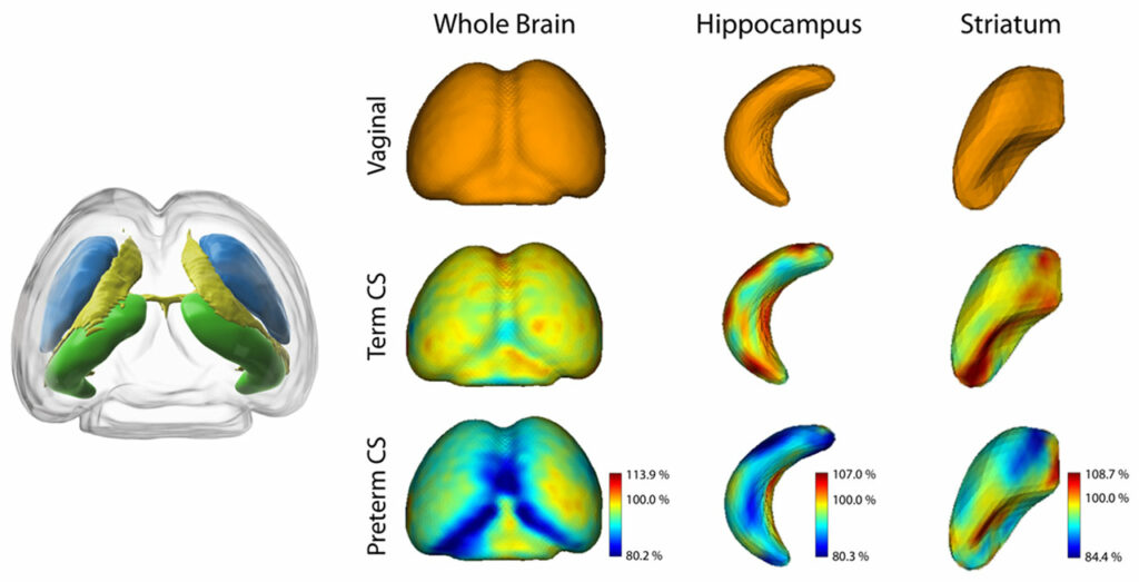 Smaller brain volumes after birth by Cesarean Section